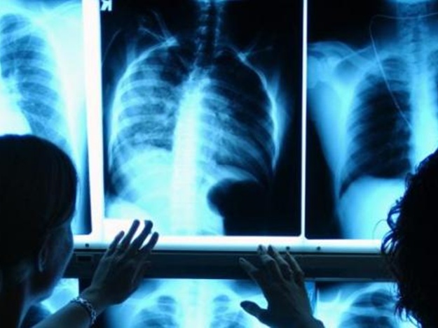На Львівщині на туберкульоз захворіло 26 дітей
