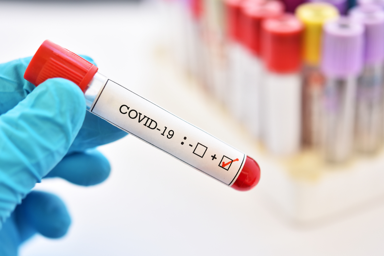 На Львівщині — 65 позитивних ПЛР-тестів, загалом - 660 інфікованих коронавірусом