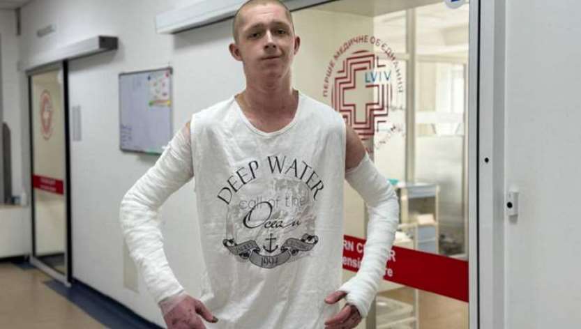 Львівські лікарі врятували 19-річного хлопця, що обпік 60% тіла